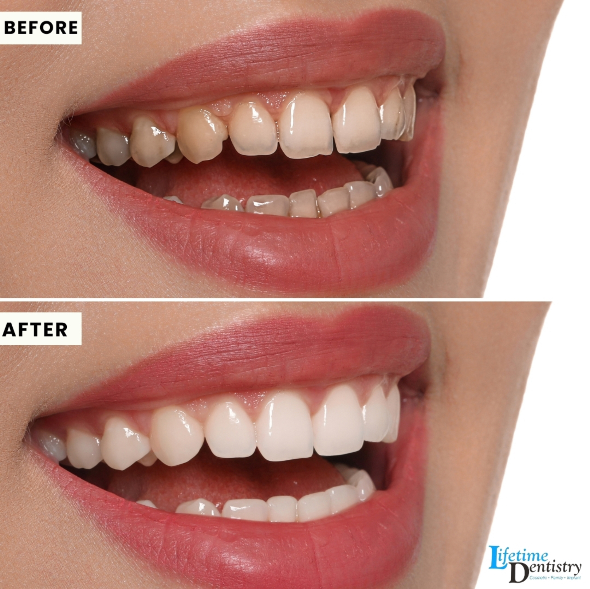 Before and after — Veneers & Alignment