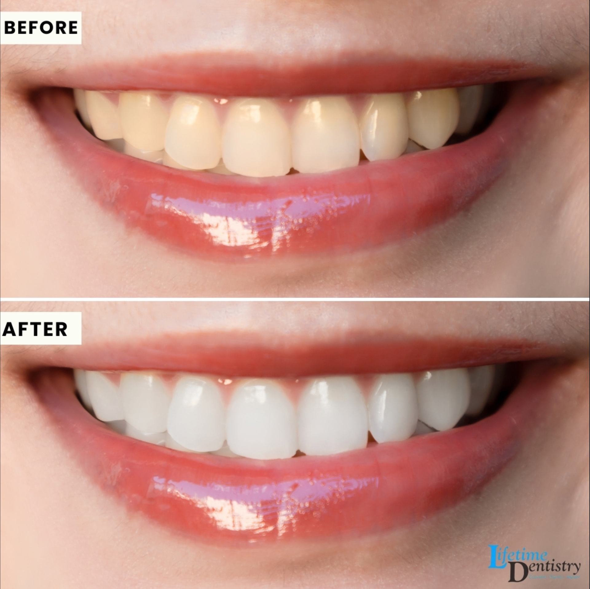Before and after — Professional Whitening