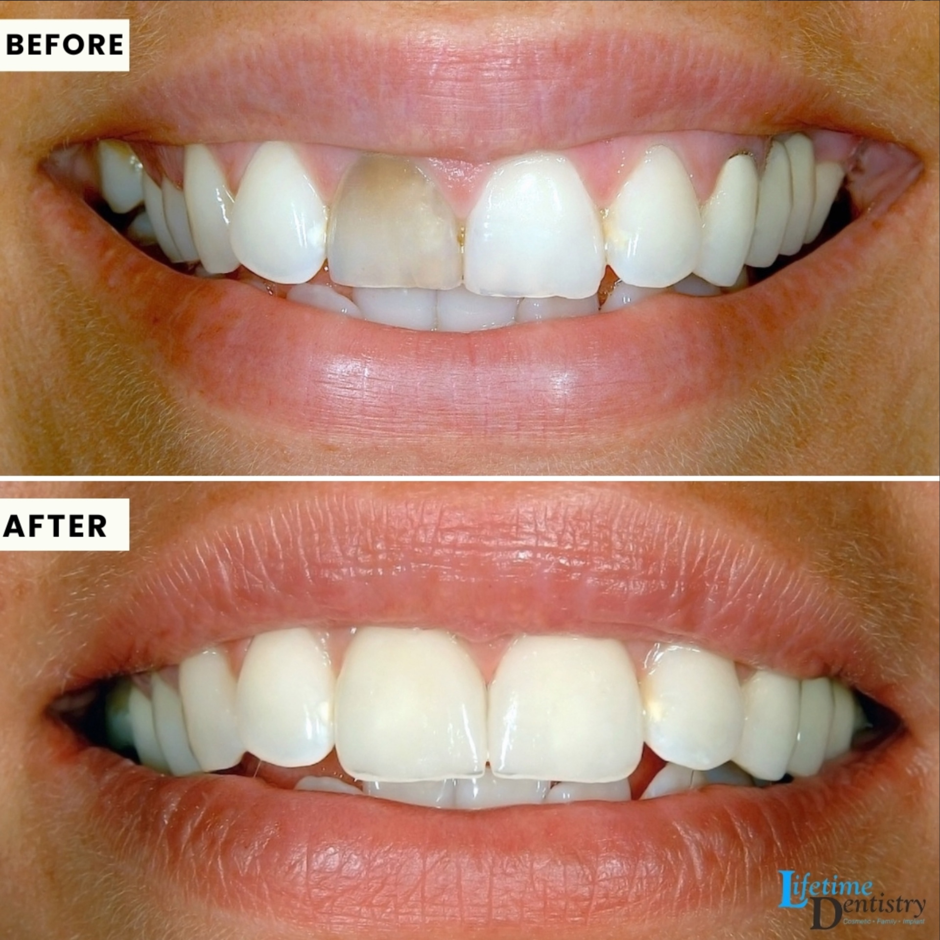 Before and after — Single-Tooth Restoration