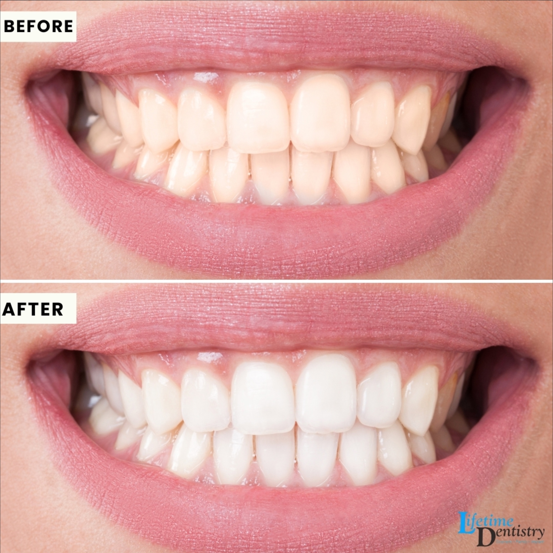 Before and after — Whitening & Polish
