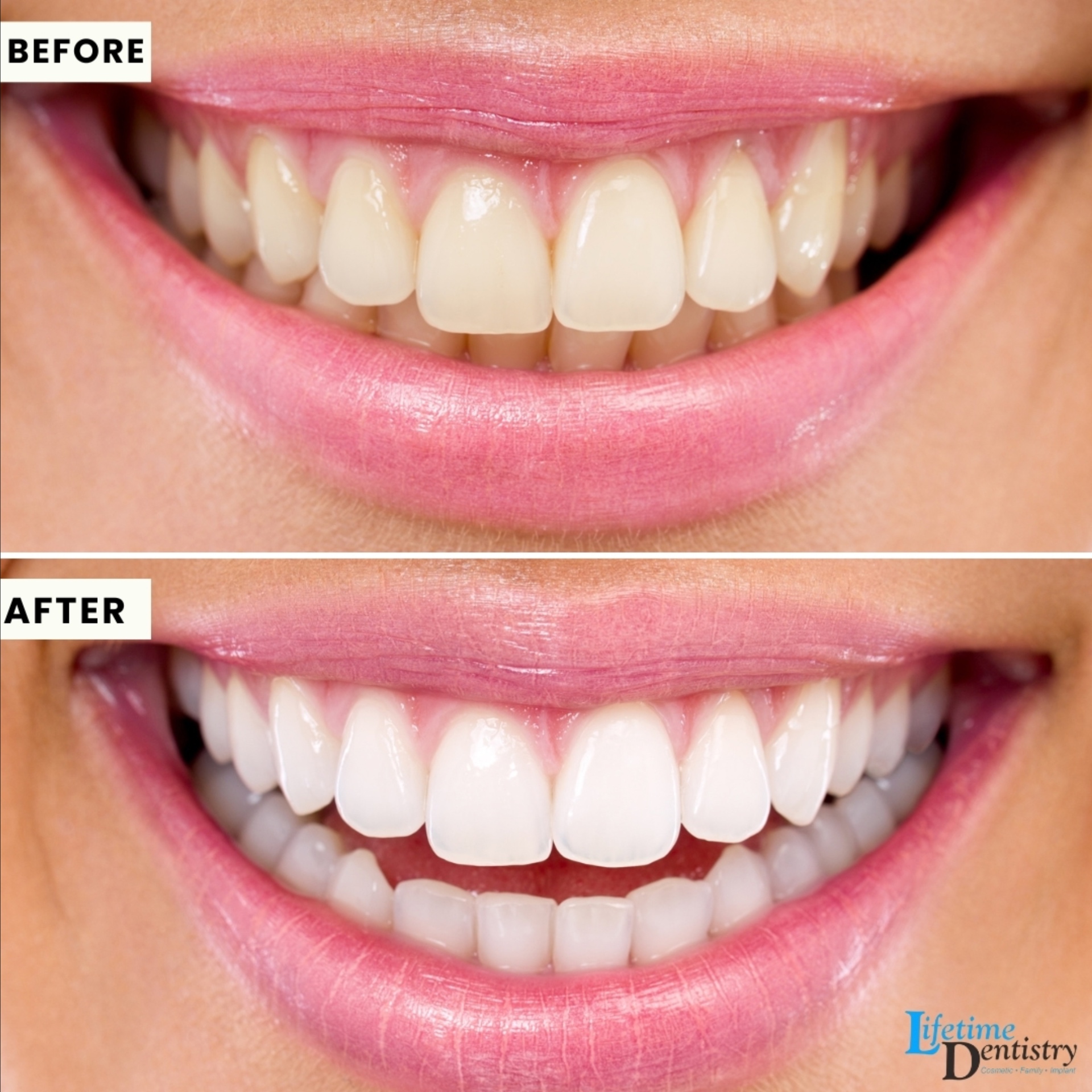 Patient smile transformation — before and after