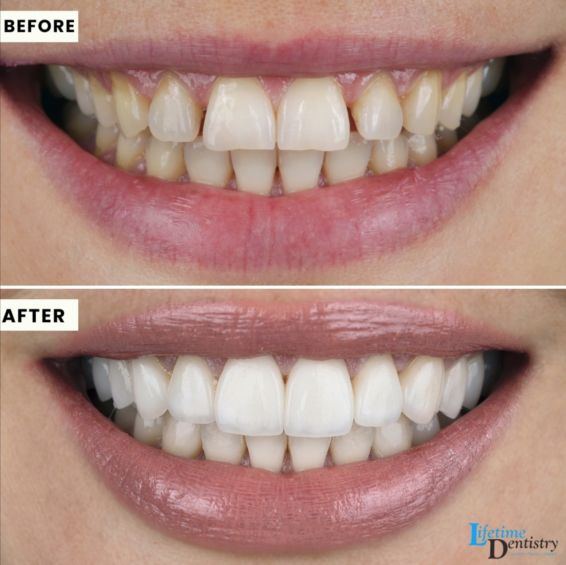 Before and after — Veneers & Color Correction
